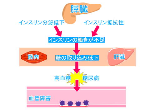 糖尿病になるメカニズムの解説イラスト